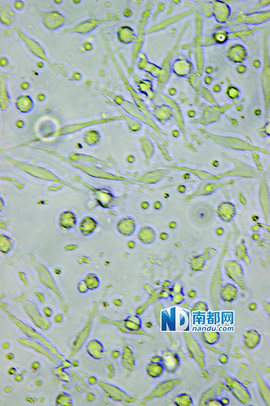 <p>    ↑目前臨床應用最廣泛的細胞生物治療是C IK細胞治療，在顯微鏡下可清晰看到D C細胞(葉片形狀)和C IK細胞(圓點形狀)。</p>